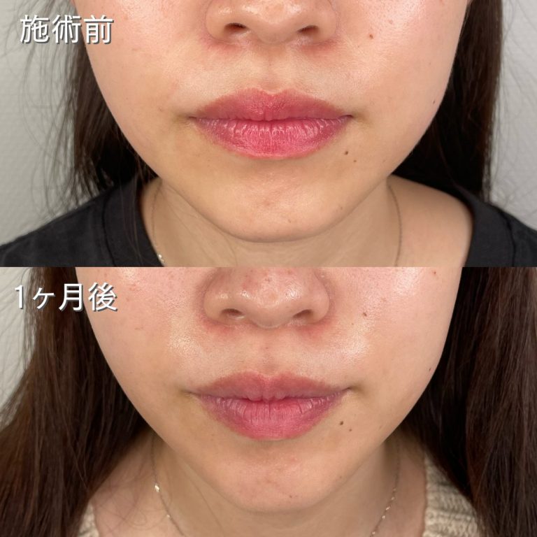小顔美肌再生（リフトアップ）(担当医:TCB 医師)の症例写真1