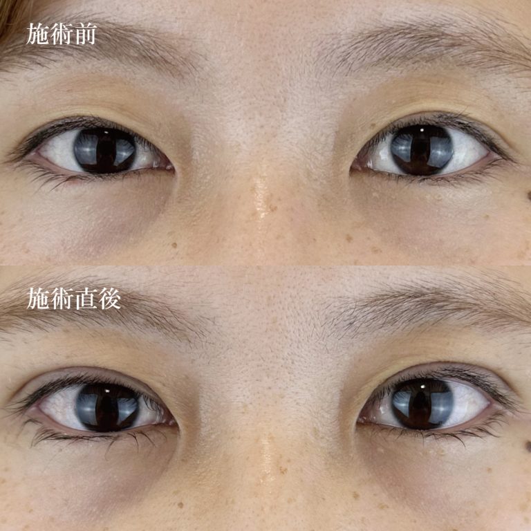 二重埋没法(担当医:TCB 医師)の症例写真1