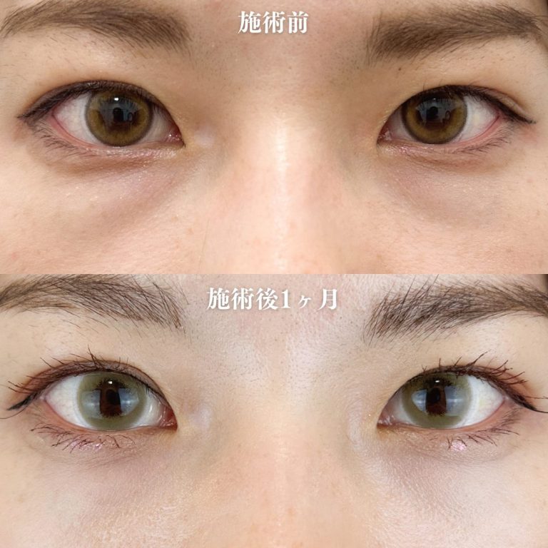 切らない目の下のクマ取り・目の下のたるみ（ふくらみ）取り(担当医:TCB 医師)の症例写真1
