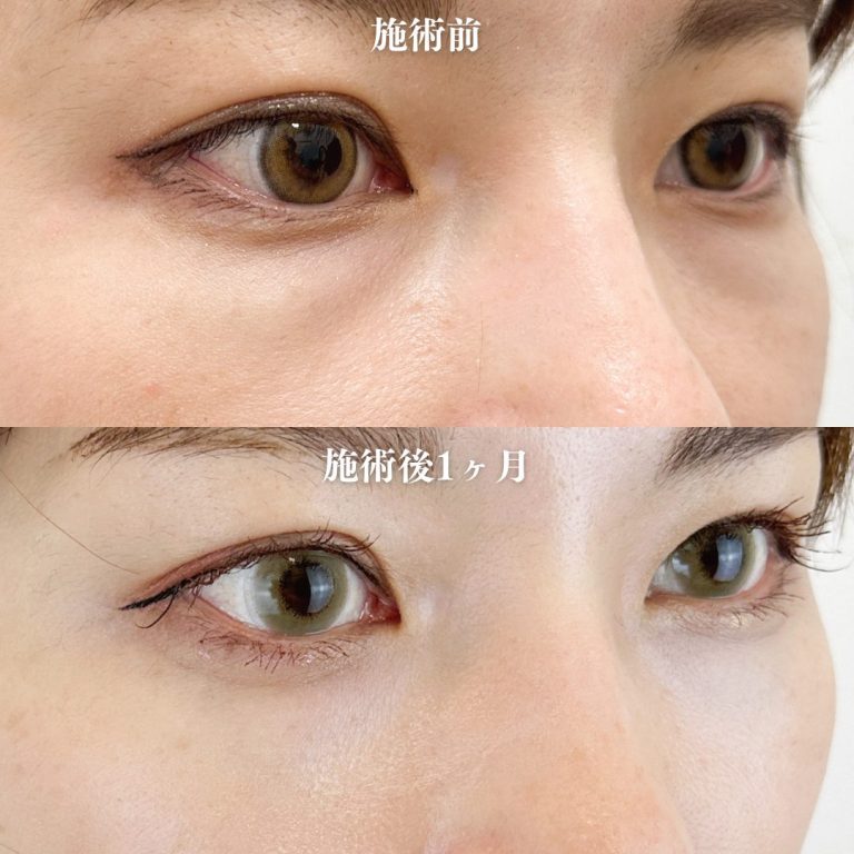 切らない目の下のクマ取り・目の下のたるみ（ふくらみ）取り(担当医:TCB 医師)の症例写真2