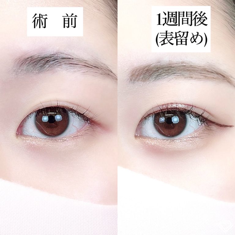 二重埋没法(担当医:TCB 医師)の症例写真1