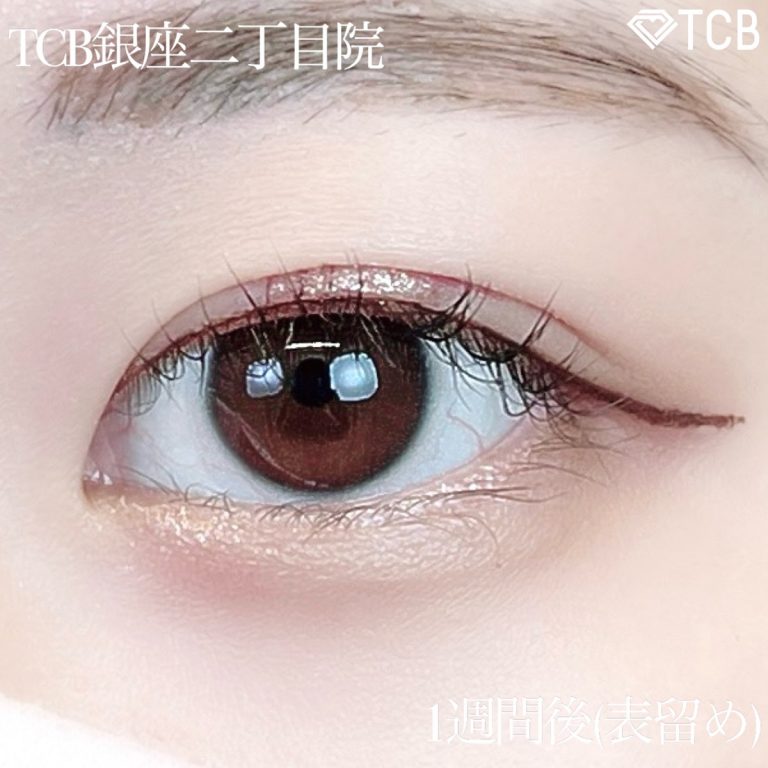 二重埋没法(担当医:TCB 医師)の症例写真2