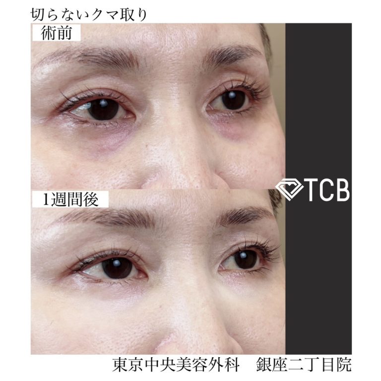 切らない目の下のクマ取り・目の下のたるみ（ふくらみ）取り(担当医:TCB 医師)の症例写真2