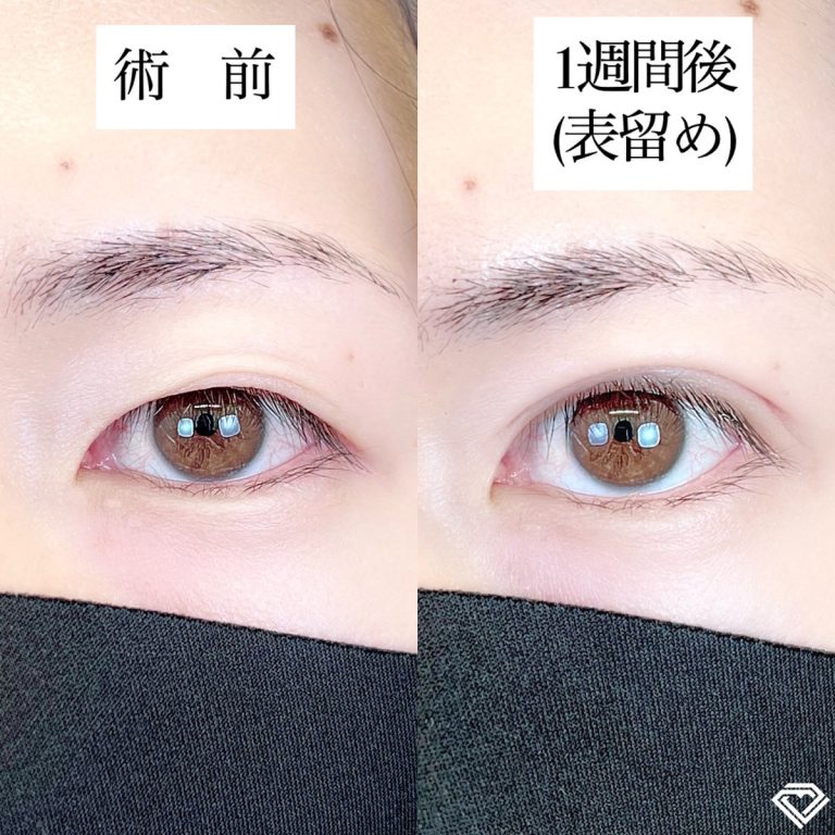 二重埋没法(担当医:TCB 医師)の症例写真1