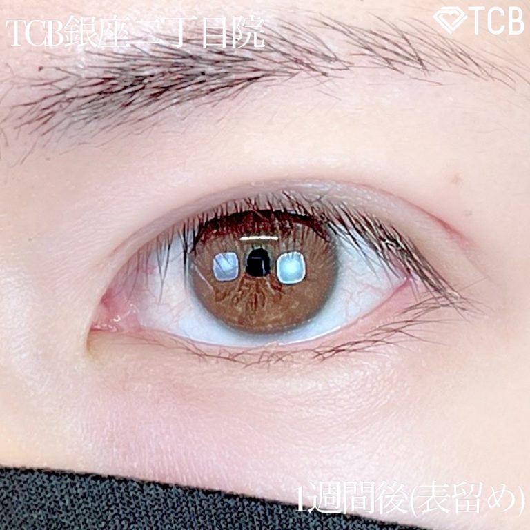二重埋没法(担当医:TCB 医師)の症例写真2