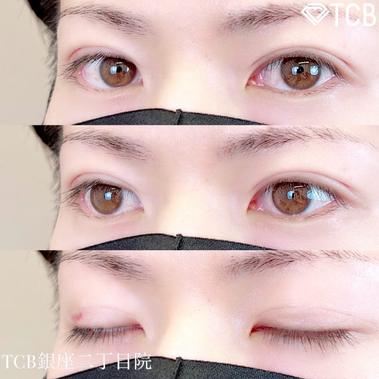 二重埋没法(担当医:TCB 医師)の症例写真3