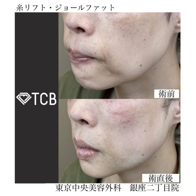 TCB小顔リフト(担当医:TCB 医師)の症例写真2