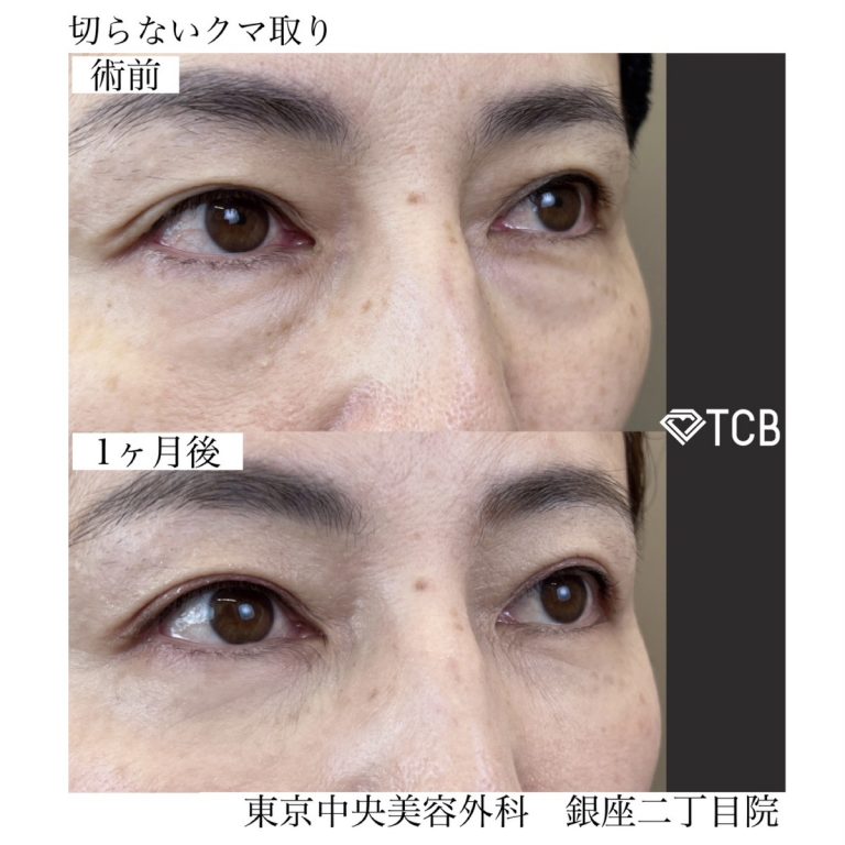 切らない目の下のクマ取り・目の下のたるみ（ふくらみ）取り(担当医:TCB 医師)の症例写真2