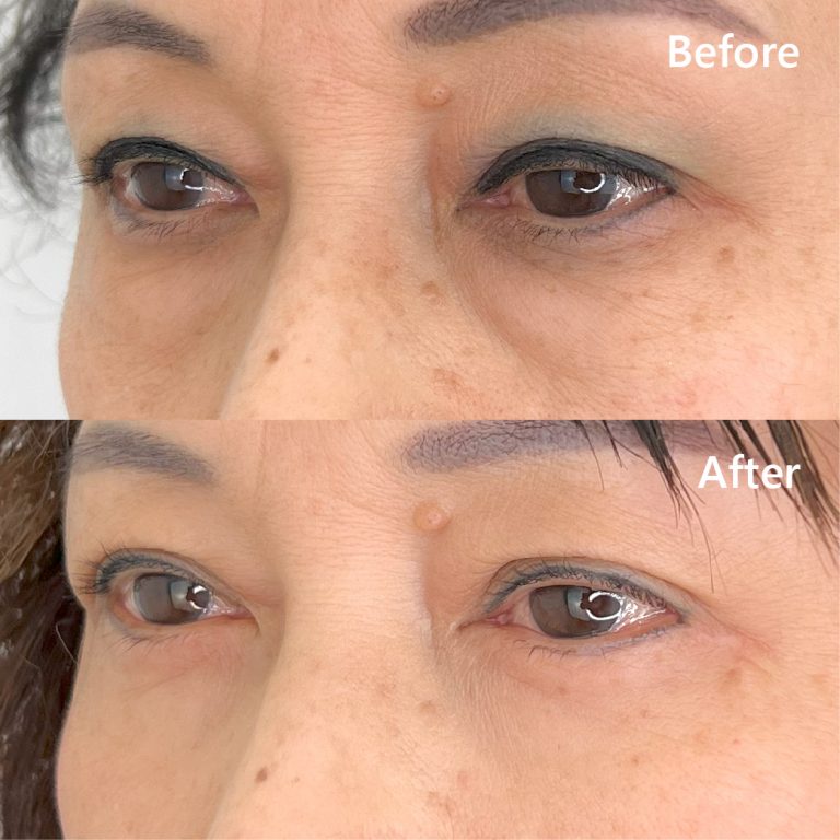 切開法による目の下のたるみ取り（下眼瞼除皺術）(担当医:坂田 将彰 医師)の症例写真2