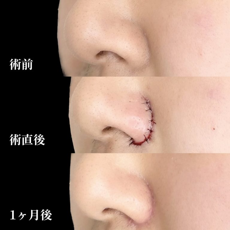 TCB式鼻翼縮小完全内側法(担当医:垣花 瑠美子 医師)の症例写真1