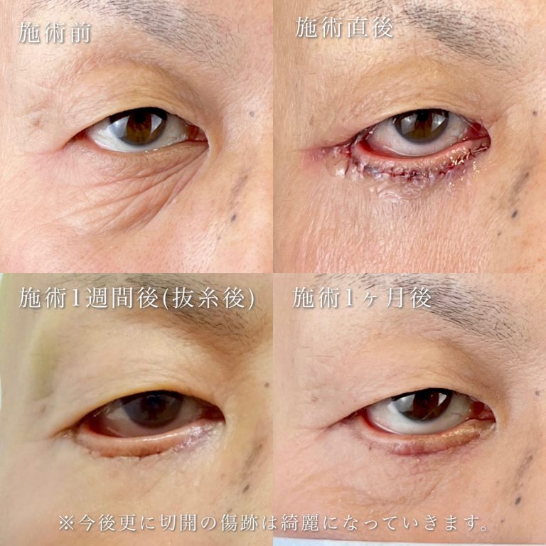 切開法による目の下のたるみ取り（下眼瞼除皺術）(担当医:河村 宜生 医師)の症例写真2