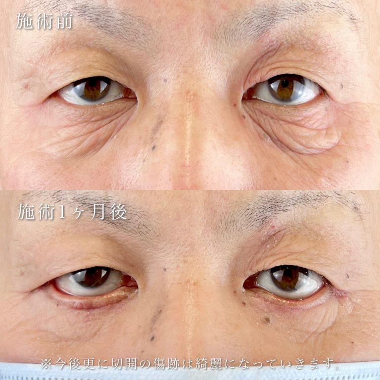 切開法による目の下のたるみ取り（下眼瞼除皺術）(担当医:河村 宜生 医師)の症例写真1