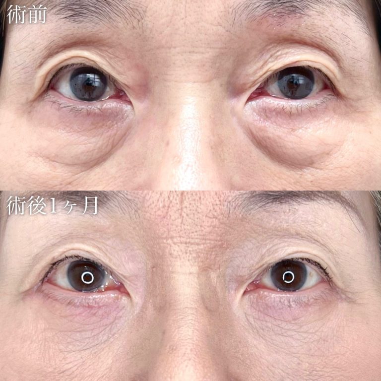 切開法による目の下のたるみ取り（下眼瞼除皺術）(担当医:TCB 医師)の症例写真1