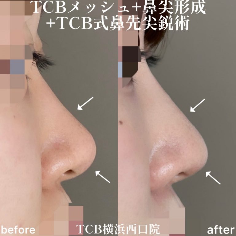 鼻尖形成(担当医:森本 理一郎 医師)の症例写真3