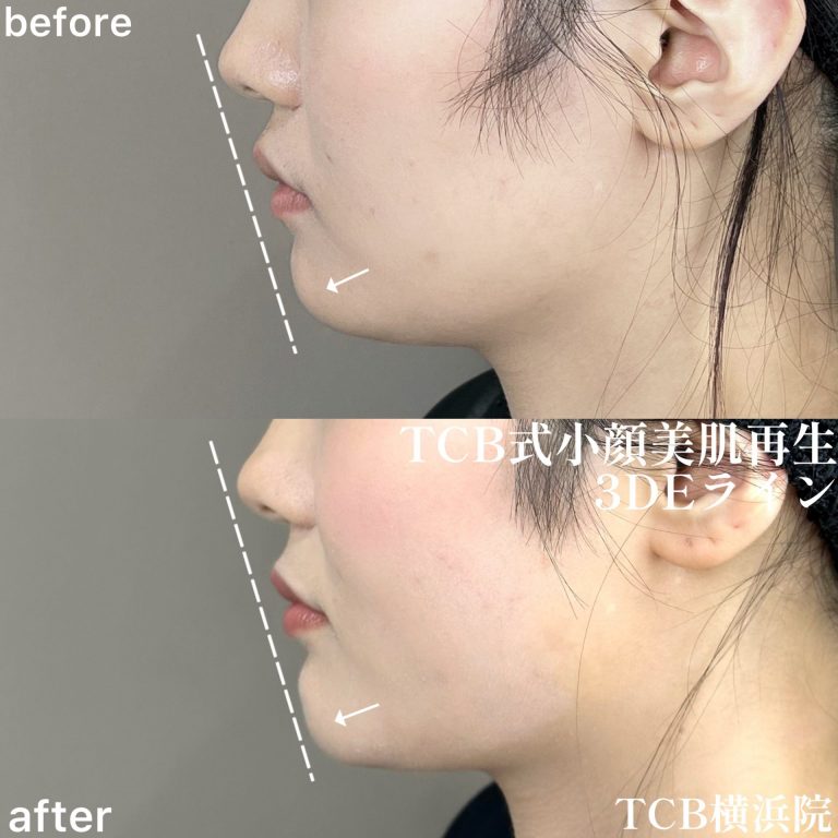 TCB式小顔美肌再生(担当医:森本 理一郎 医師)の症例写真3