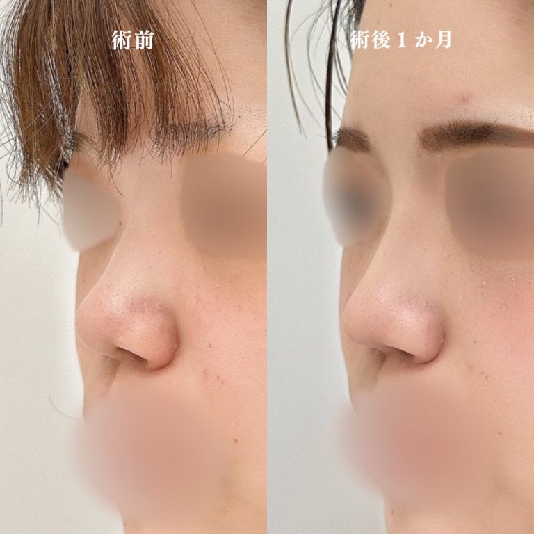 鼻尖形成(担当医:林 一樹 医師)の症例写真1