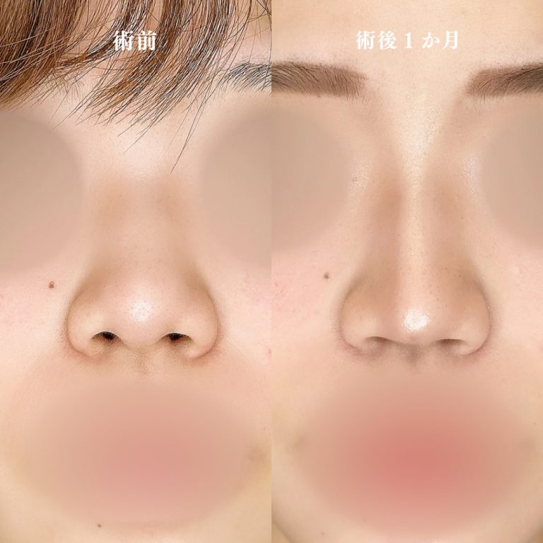 鼻尖形成(担当医:林 一樹 医師)の症例写真3