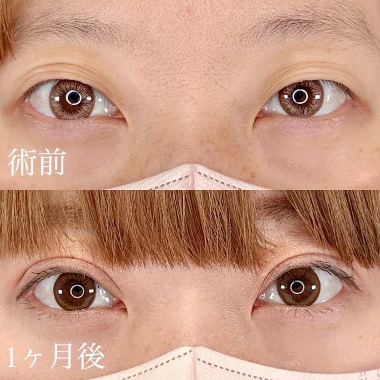 二重埋没法(担当医:TCB 医師)の症例写真1