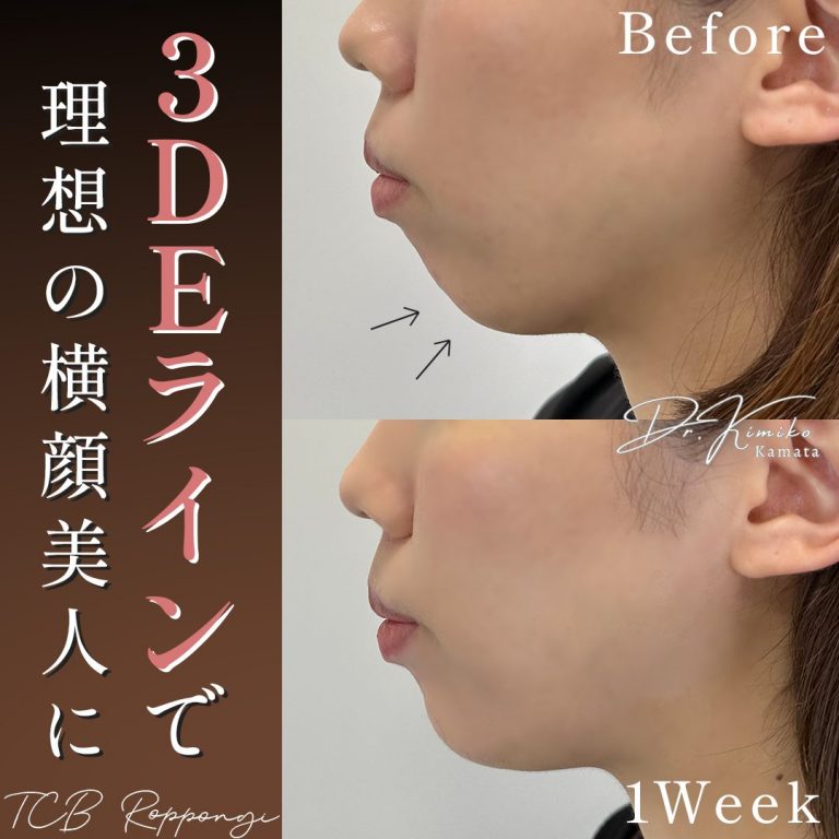 切らない顎形成 3D Eライン(担当医:鎌田 紀美子 医師)の症例写真1