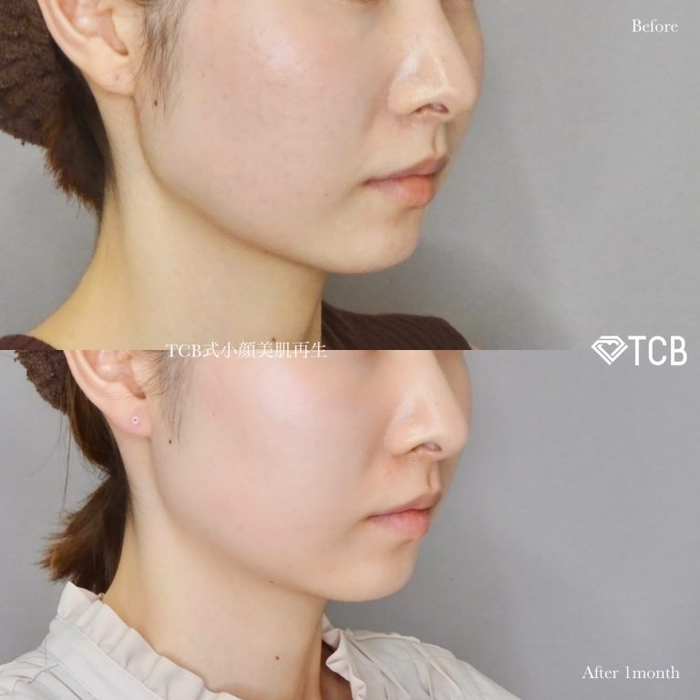 TCB式小顔美肌再生(担当医:佐藤 麻未 医師)の症例写真3