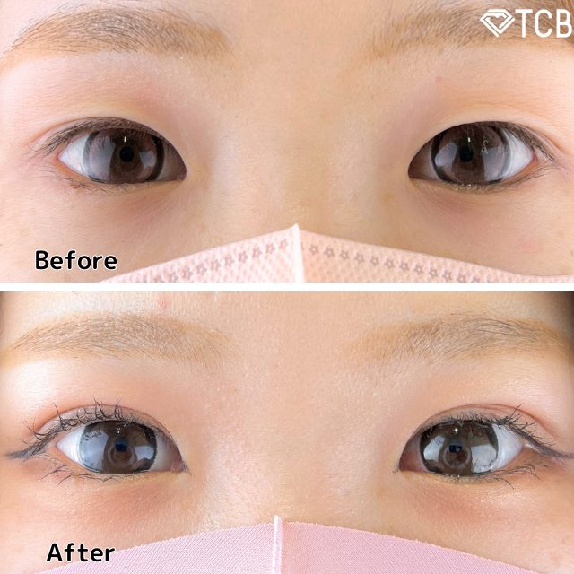 二重埋没法(担当医:TCB 医師)の症例写真1