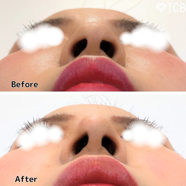 鼻プロテーゼ（隆鼻術）(担当医:TCB 医師)の症例写真1