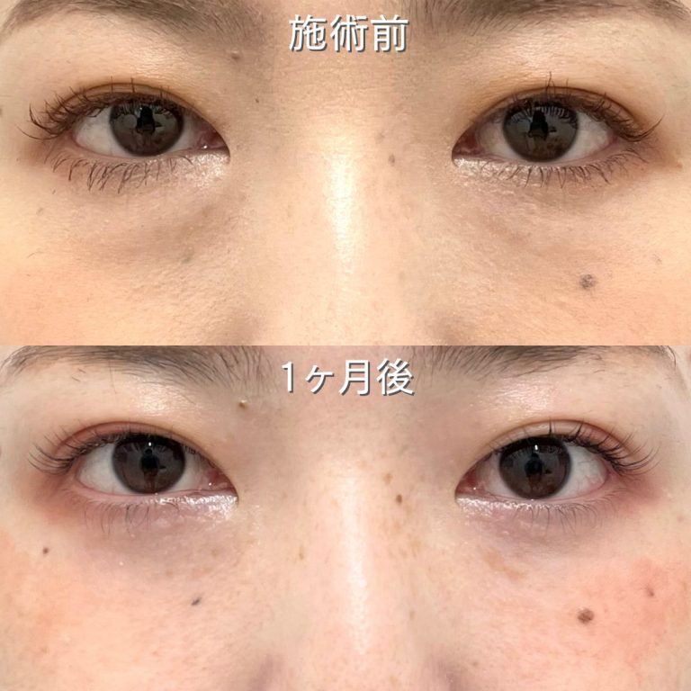 切らない目の下のクマ取り・目の下のたるみ（ふくらみ）取り(担当医:壷井 友里恵 医師)の症例写真1