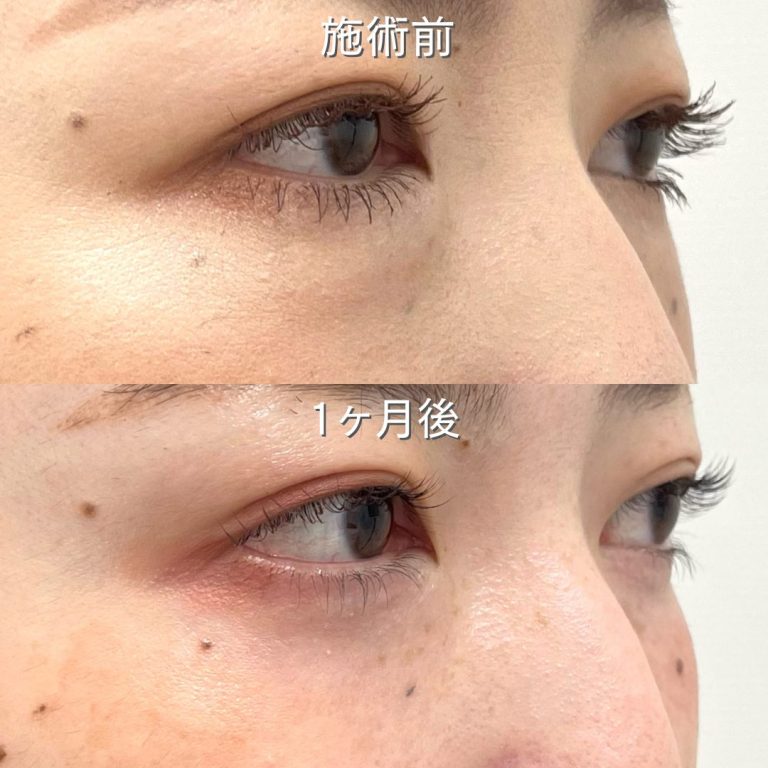 切らない目の下のクマ取り・目の下のたるみ（ふくらみ）取り(担当医:壷井 友里恵 医師)の症例写真2