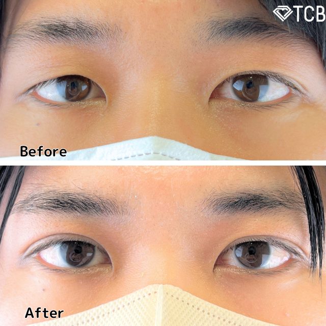 二重埋没法(担当医:TCB 医師)の症例写真1