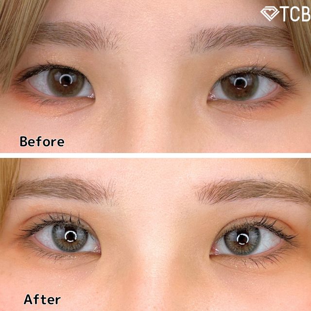 二重埋没法(担当医:TCB 医師)の症例写真1