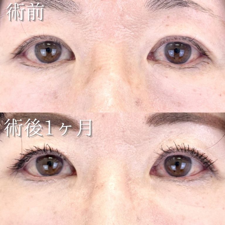 切開法による目の下のたるみ取り（下眼瞼除皺術）(担当医:佐藤 直弥 医師)の症例写真1