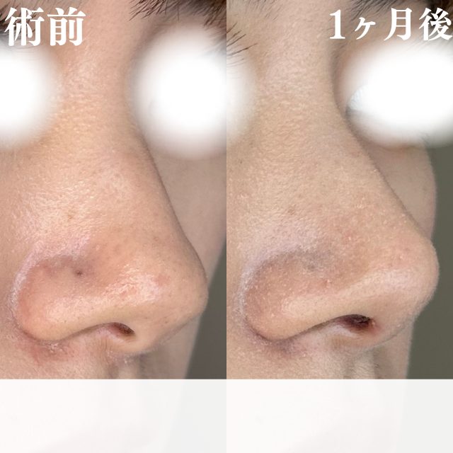 鼻尖形成(担当医:大隈 宏通 医師)の症例写真2