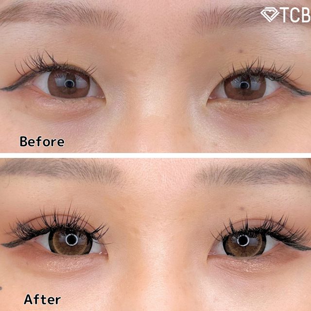 二重埋没法(担当医:TCB 医師)の症例写真1