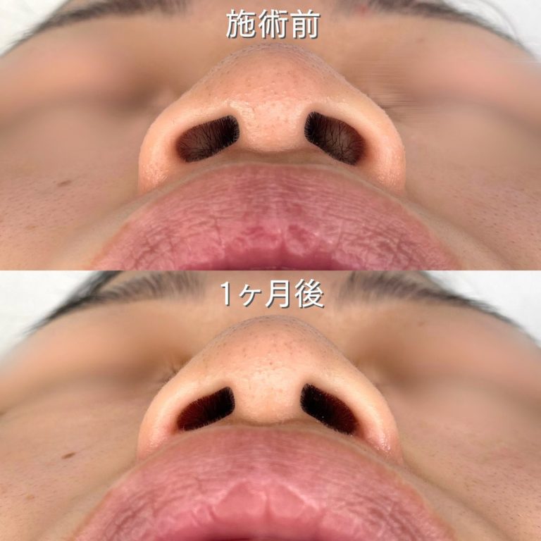 TCB式鼻翼縮小完全内側法(担当医:TCB 医師)の症例写真2