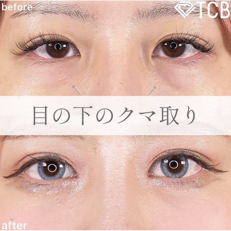 切らない目の下のクマ取り・目の下のたるみ（ふくらみ）取り(担当医:TCB 医師)の症例写真1