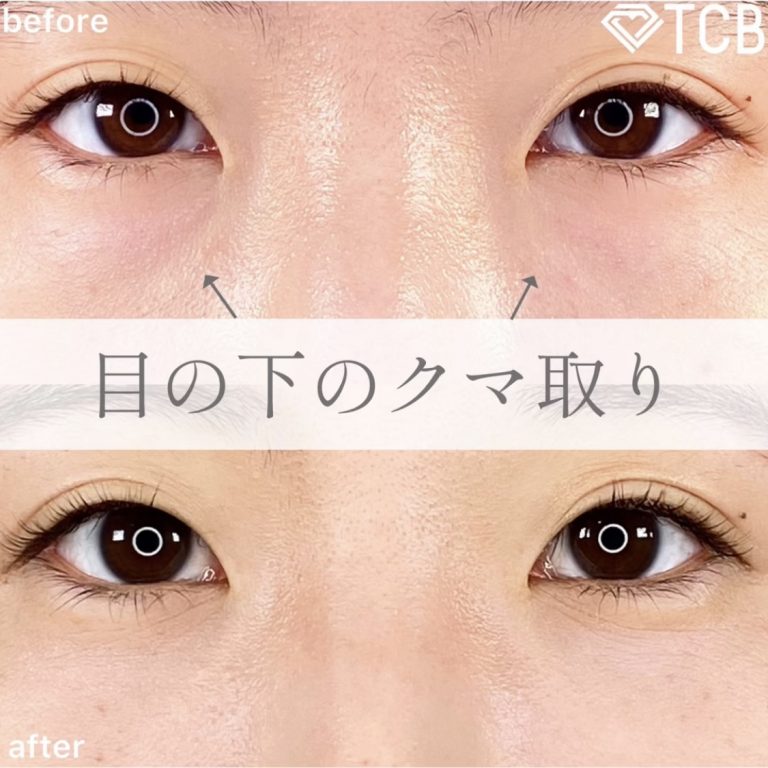 切らない目の下のクマ取り・目の下のたるみ（ふくらみ）取り(担当医:TCB 医師)の症例写真1