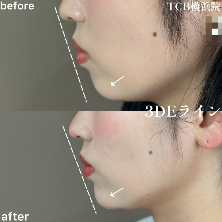 切らない顎形成 3D Eライン(担当医:森本 理一郎 医師)の症例写真3