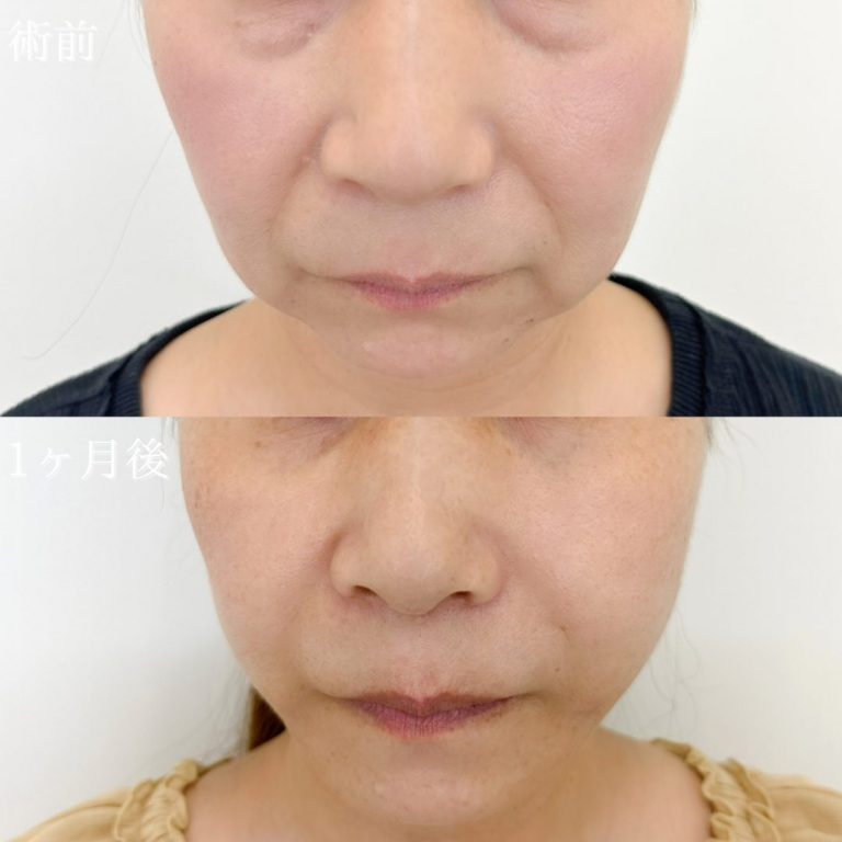 TCB式小顔美肌再生(担当医:坂本 桂子 医師)の症例写真1