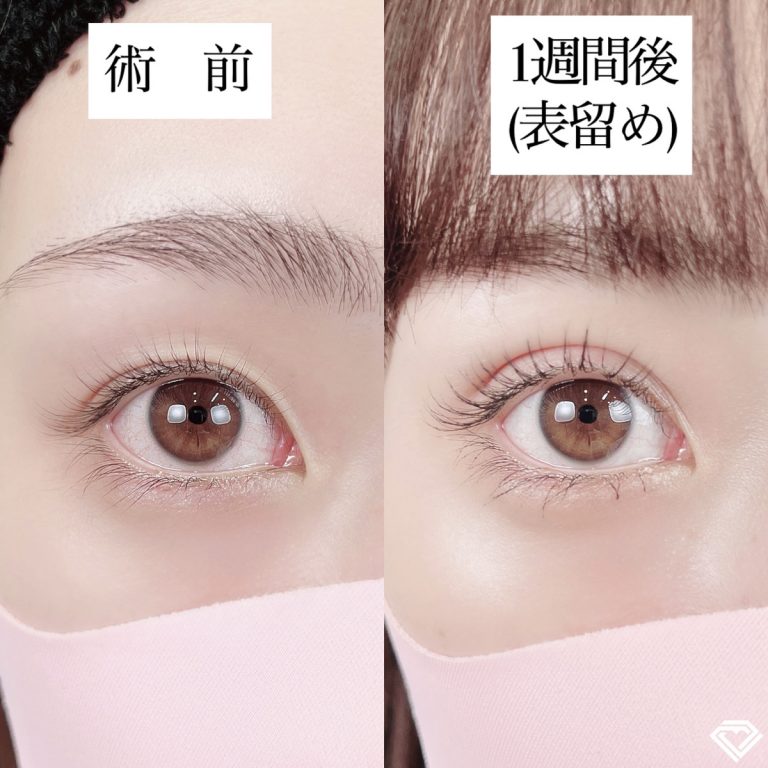 二重埋没法(担当医:TCB 医師)の症例写真1