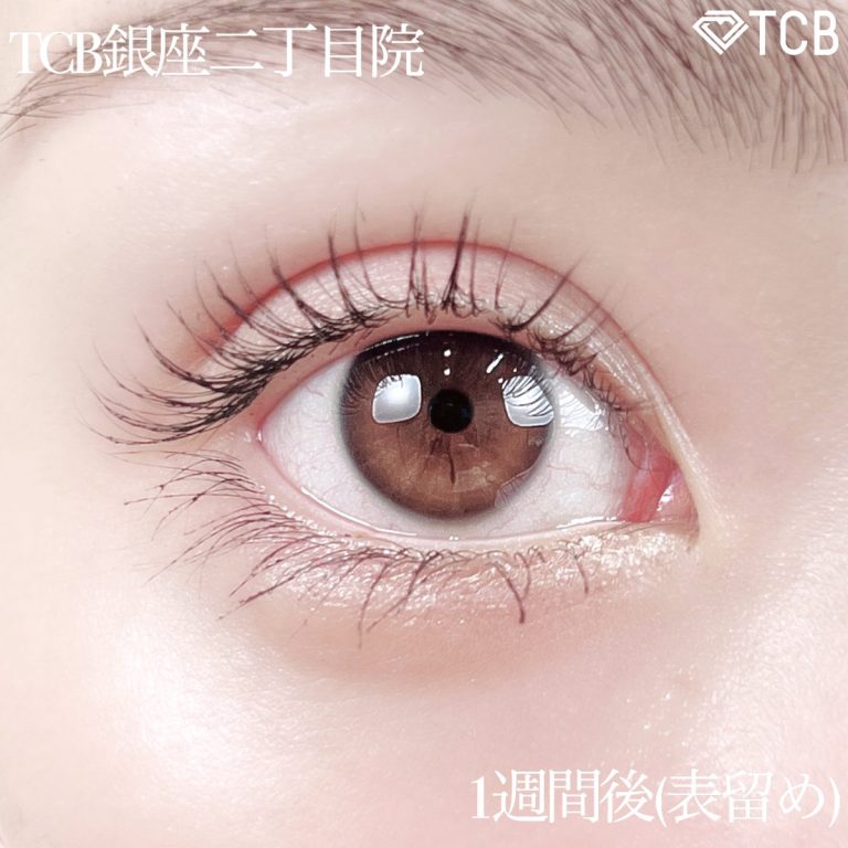 二重埋没法(担当医:TCB 医師)の症例写真2