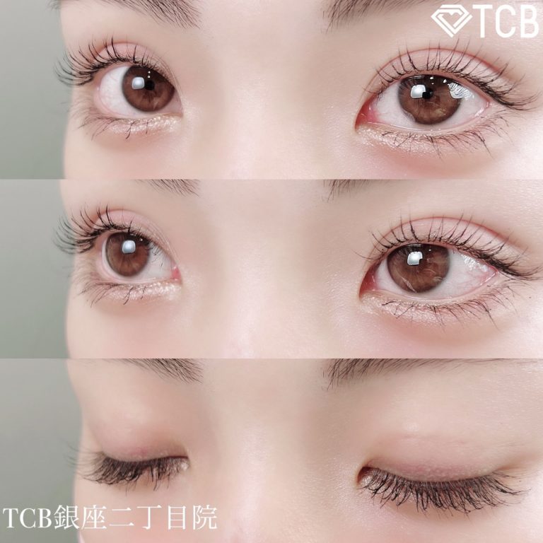 二重埋没法(担当医:TCB 医師)の症例写真3