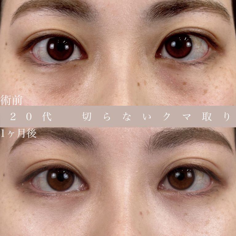 切らない目の下のクマ取り・目の下のたるみ（ふくらみ）取り(担当医:TCB 医師)の症例写真1