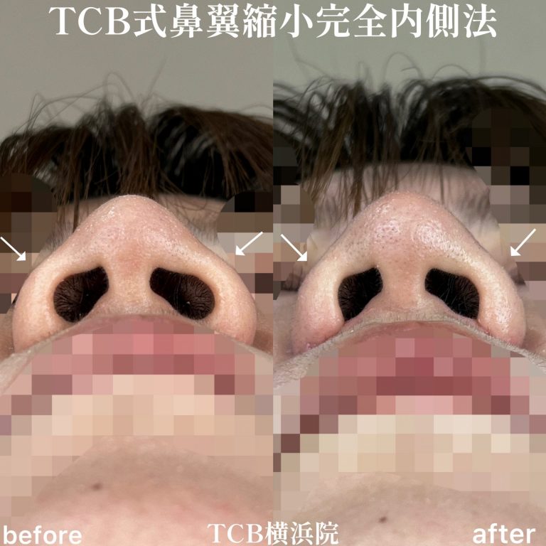 TCB式鼻翼縮小完全内側法・外側法(担当医:TCB 医師)の症例写真3