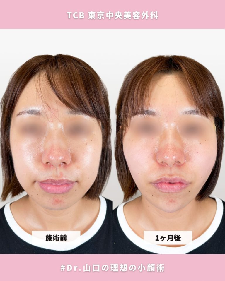 TCB式小顔美肌再生(担当医:山口 太朗 医師)の症例写真1