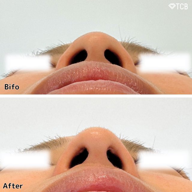 鼻尖形成(担当医:TCB 医師)の症例写真1