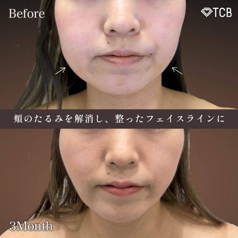 TCB式小顔脂肪吸引(担当医:鎌田 紀美子 医師)の症例写真2