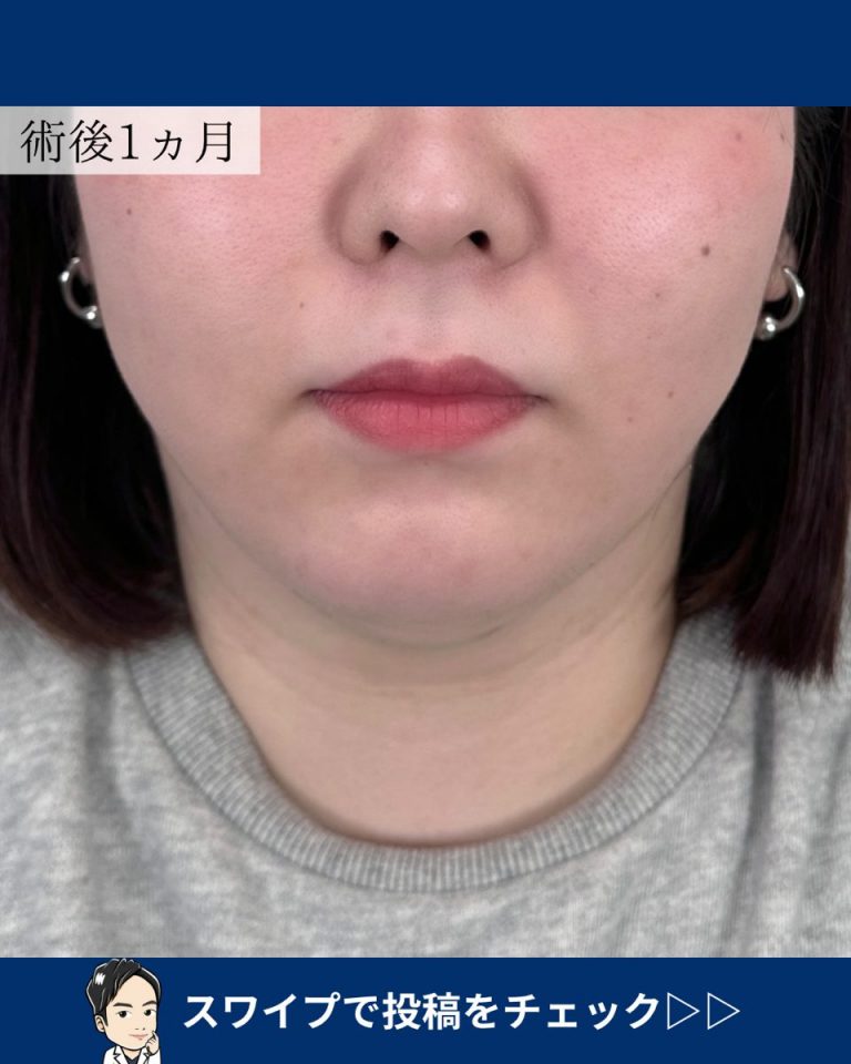 TCB式小顔脂肪吸引(担当医:宗像 寿祥 医師)の症例写真3