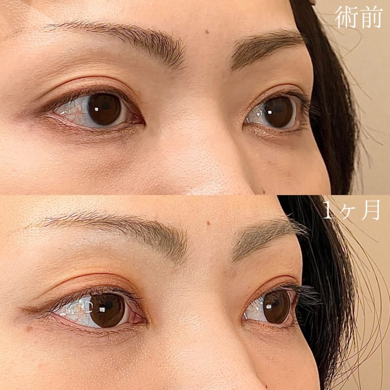 切らない目の下のクマ取り・目の下のたるみ（ふくらみ）取り(担当医:TCB 医師)の症例写真1