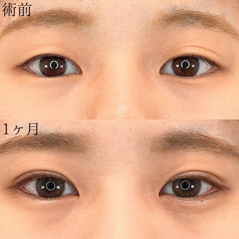 二重埋没法(担当医:TCB 医師)の症例写真1