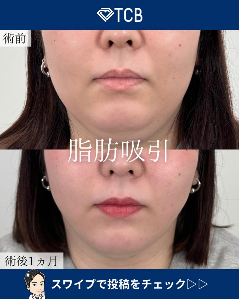 TCB式小顔脂肪吸引(担当医:宗像 寿祥 医師)の症例写真1